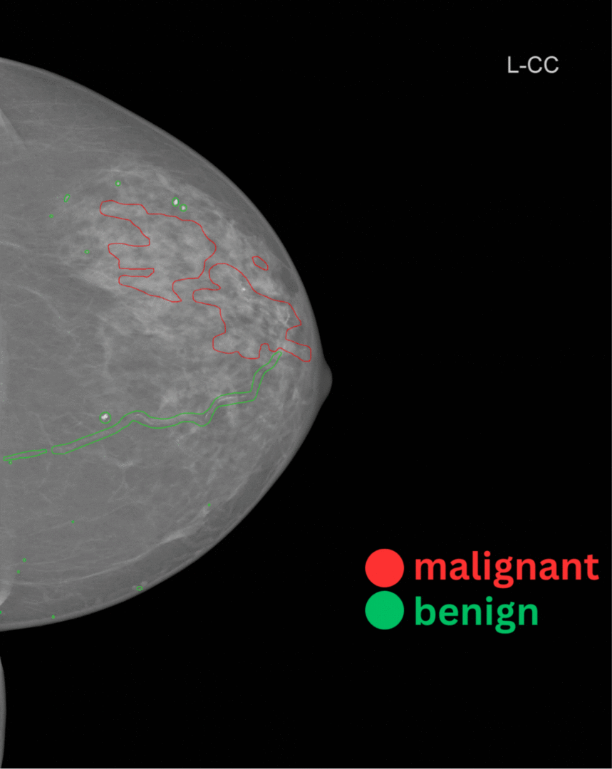 Analysis of visual mammographic examinations for radiology